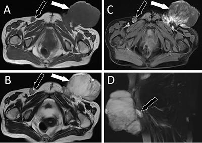 Case Report: Inguinal Myxofibrosarcoma Arising From the Surgical Site of Resected Squamous Cell Carcinoma